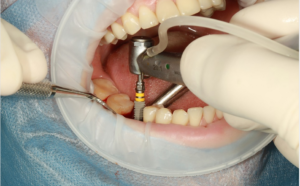 dental implants