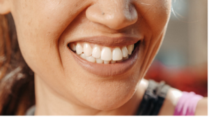 teeth whitening